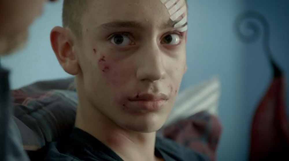 A closeup of a teenage boy, his face covered in scratches, scars, and plasters.